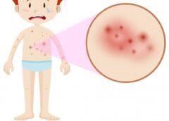 Eczema Information You Need To Know About - MultiTechGuru
