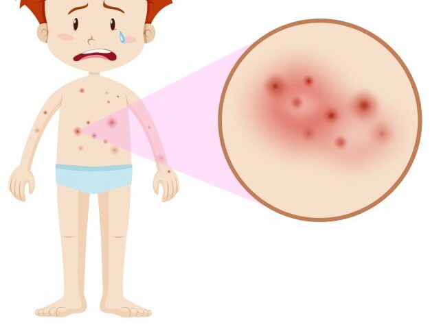 Eczema Information You Need To Know About - MultiTechGuru