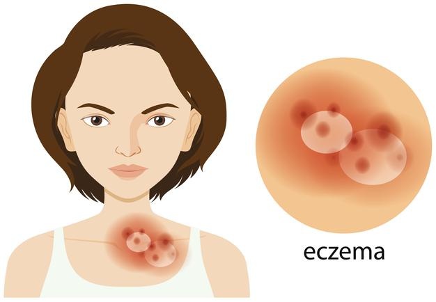 Eczema Tips That Will Truly Work For You - MultiTechGuru