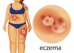 Everything You Always Wanted To Know About Eczema - MultiTechGuru