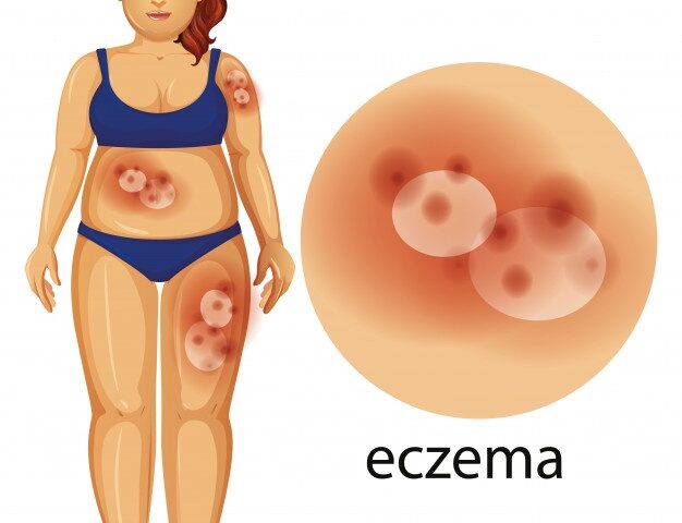 Everything You Always Wanted To Know About Eczema - MultiTechGuru