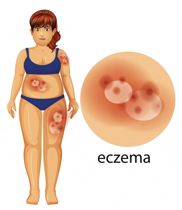 Everything You Always Wanted To Know About Eczema - MultiTechGuru