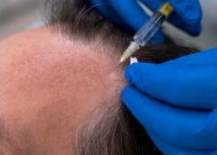 Ideas You Can Use When Facing Hair Loss - MultiTechGuru