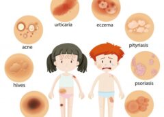 These Tips Can Help You Cope With Eczema - MultiTechGuru