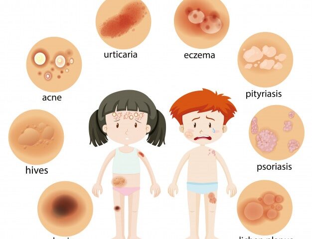 These Tips Can Help You Cope With Eczema - MultiTechGuru