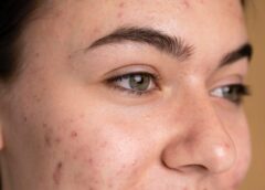 Tips To Clear Up Acne Now And Prevent It Later - MultiTechGuru