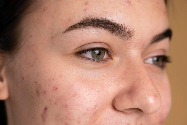Tips To Clear Up Acne Now And Prevent It Later - MultiTechGuru