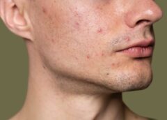 Ways To Get Rid Of Acne Today - MultiTechGuru