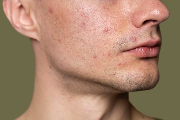 Ways To Get Rid Of Acne Today - MultiTechGuru