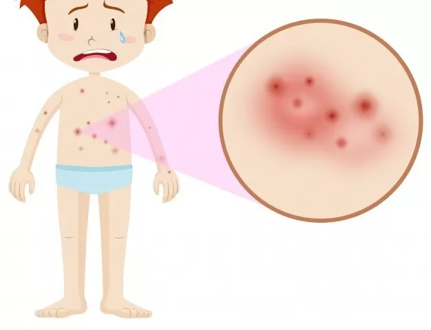 Eczema Information You Need To Know About - MultiTechGuru