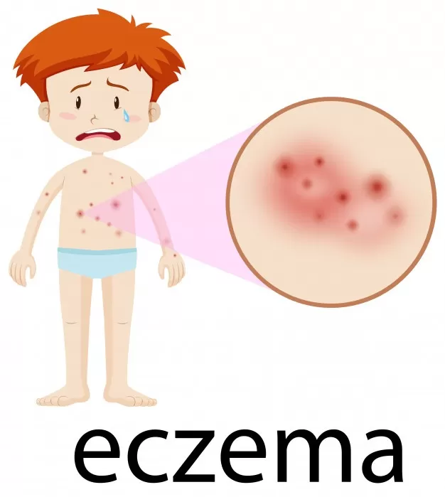 Eczema Information You Need To Know About - MultiTechGuru