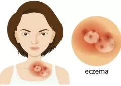 Eczema Tips That Will Truly Work For You - MultiTechGuru