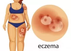 Everything You Always Wanted To Know About Eczema - MultiTechGuru