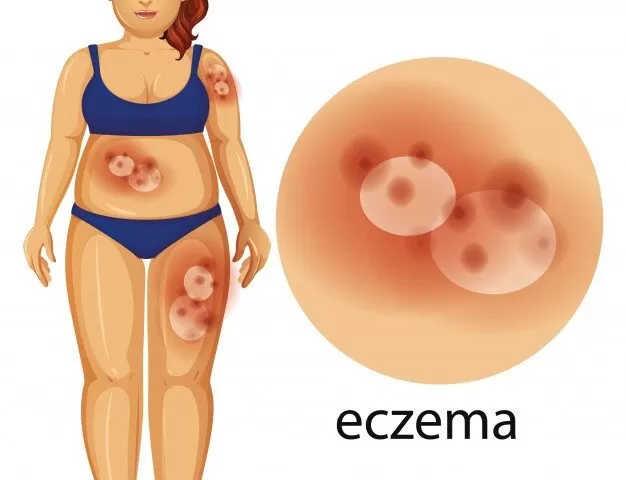 Everything You Always Wanted To Know About Eczema - MultiTechGuru